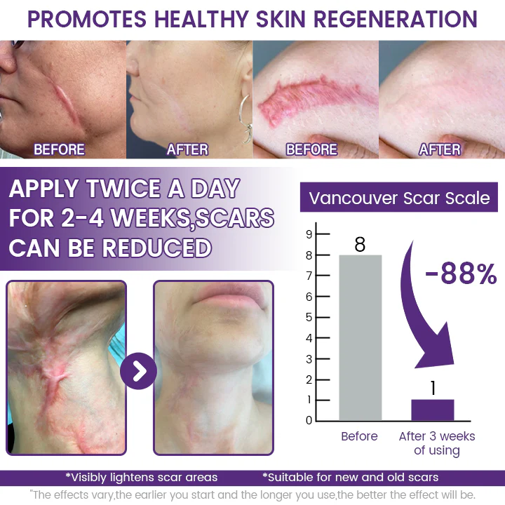 Timilk Regenscar Scar Gel 20g – Triple Action Gel for Old & New Scars